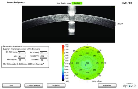 corneal thickness measurement instruments|corneal thickness pachy chart.